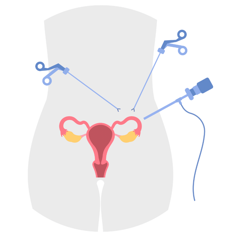 Operative Laparoscopy