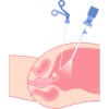 Evaluation of Infertility